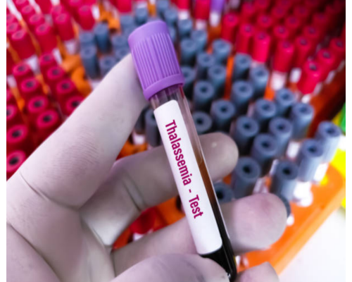 Causes, Symptoms, and Treatment of Thalassemia