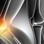Arthritis: Types and Treatment Options