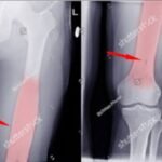 Bone Lesions: Causes, Symptoms, Diagnosis, and Treatment