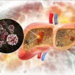Liver Cancer: Causes, Symptoms, and Treatment