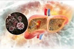 Liver Cancer: Causes, Symptoms, and Treatment