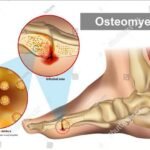 Orthopaedic Infections: Causes, Symptoms, and Treatment