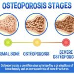 The Silent Thief of Bone Health