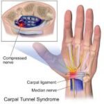 A Basic Guide for the Diagnosis of Carpal Tunnel Syndrome