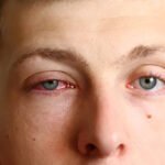 Viral Conjunctivitis: Symptoms, Treatments, and Prevention