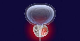 Prostate Cancer: Causes, Symptoms, and Treatment