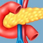 Pancreatic Cancer: Understanding the Silent Killer