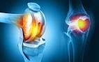 Enhancing Mobility and Quality of Life Through Joint Replacement Surgery
