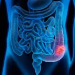 Colorectal Cancer: Symptoms, Risk Factors, and Prevention