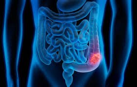 Colorectal Cancer: Symptoms, Risk Factors, and Prevention