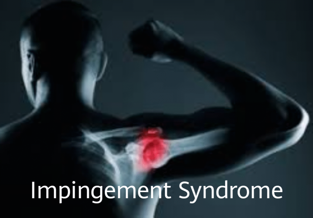 Shoulder Impingement Syndrome: Causes, Signs, and Treatment