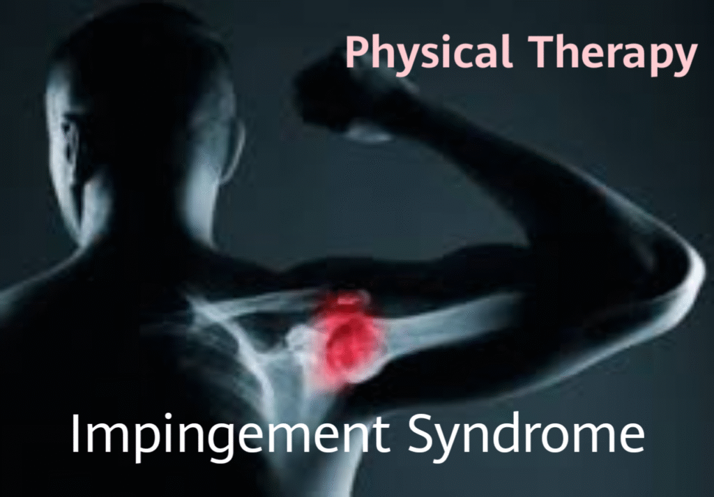 How Physical Therapy Can Help Manage Impingement Syndrome