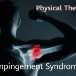 How Physical Therapy Can Help Manage Impingement Syndrome