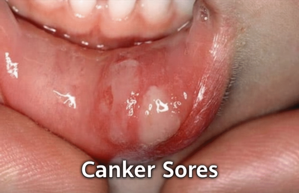 Canker Sores and Their Treatment Options