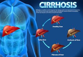 Cirrhosis: Understanding the Silent Liver Disease