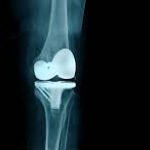 Knee Replacement Surgery: A New Lease on Mobility
