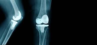 Knee Replacement Surgery: A New Lease on Mobility