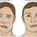 Facial Palsy: Causes, Symptoms, and Treatment