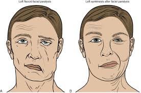 Facial Palsy: Causes, Symptoms, and Treatment