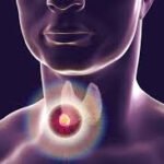 Thyroid Cancer: Causes, Symptoms, and Treatment