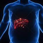 Fatty Liver Disease: Causes, and Prevention