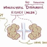 Multicystic Dysplastic Kidney: Causes, Symptoms, and Treatment