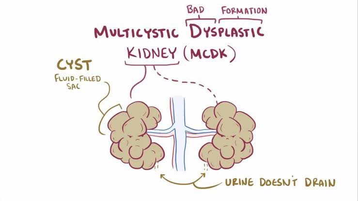 Multicystic Dysplastic Kidney: Causes, Symptoms, and Treatment