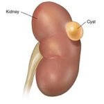 Simple Kidney Cysts: A Common and Benign Condition