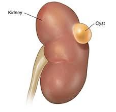 Simple Kidney Cysts: A Common and Benign Condition