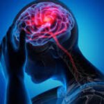 Brain Cancer: Causes, Symptoms, Diagnosis, and Treatment