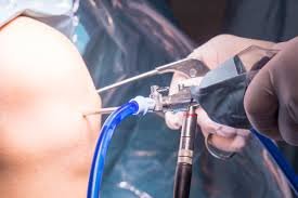 Arthroscopic Surgery: A Minimally Invasive Breakthrough