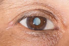 Cataracts: Causes, Symptoms, and Treatment
