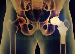 Hip Replacement: Restoring Mobility and Quality of Life