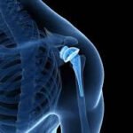 Shoulder Replacement Surgery: Restoring Mobility and Quality of Life