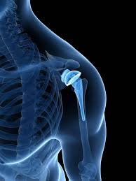 Shoulder Replacement Surgery: Restoring Mobility and Quality of Life