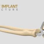 Elbow Implants: Restoring Mobility and Quality of Life
