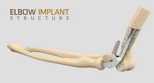 Elbow Implants: Restoring Mobility and Quality of Life