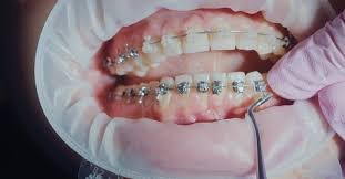 The Evolution of Braces and Orthodontics: A Smile-Transforming Journey