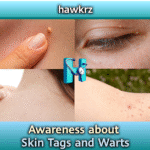 Exploring Skin Tags and Warts: Causes, Differences, and Treatment Options