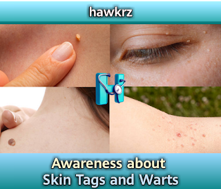Exploring Skin Tags and Warts: Causes, Differences, and Treatment Options