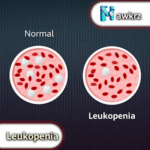 Leukopenia: Causes, Symptoms, and Treatment Options