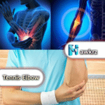 Tennis Elbow: Symptoms, Causes, and Treatment Options