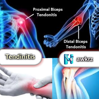 Tendinitis: Symptoms, Causes, and Treatment Strategies