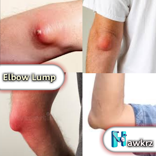 Elbow Lumps: Causes, Symptoms, and Treatment Options