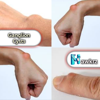 Ganglion Cysts: Causes, Symptoms, and Treatment Options