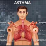 Asthma Symptoms, Causes, and Treatment