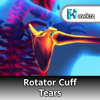 Rotator Cuff Tears: Symptoms, Causes, and Treatment Strategies