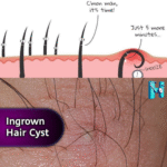 Taming the Tiny Terror: Conquering Ingrown Hair Cysts